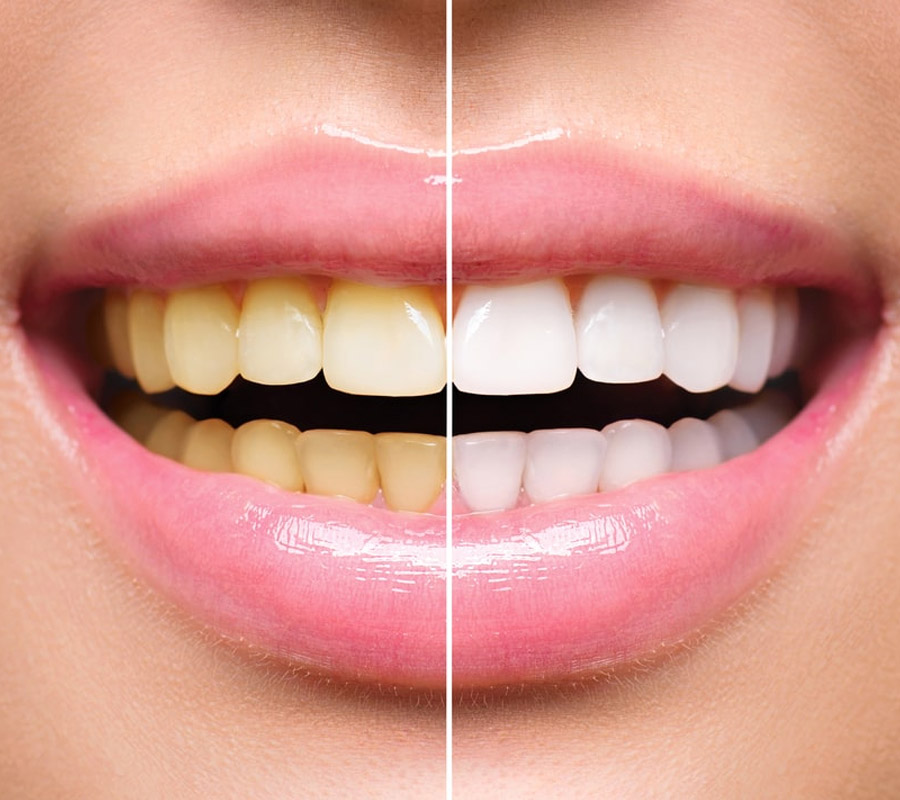 clareamento-dental